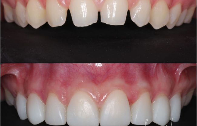 Composite Veneers Before & After